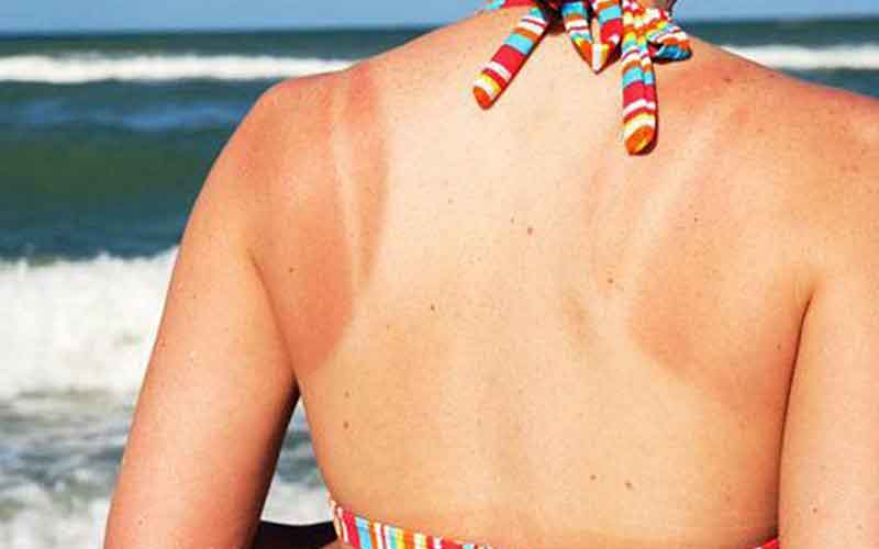 Nếu sau khi bơi bạn vẫn tiếp xúc trực tiếp với nắng thì chả mấy chốc da của bạn sẽ đổi màu đấy.