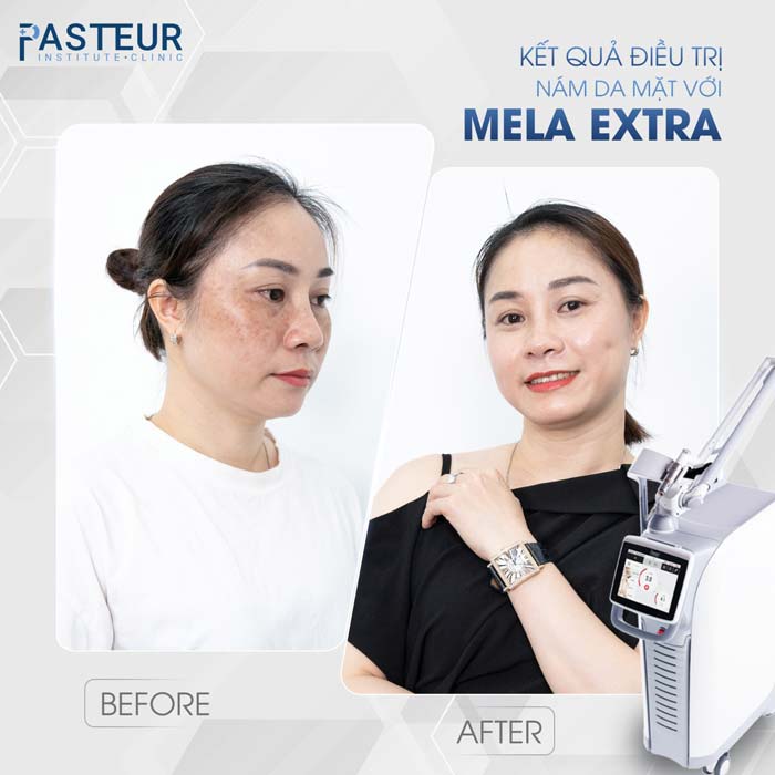 Chị Trang điều trị nám thành công tại phòng khám da liễu Pasteur